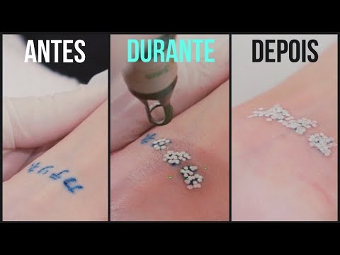 REMOÇÃO DE TATUAGEM - LASER TATTOO REMOVAL